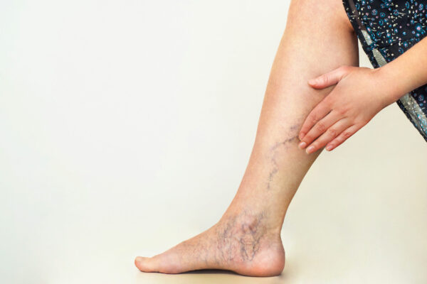 Examination of varicose veins on the womans legs