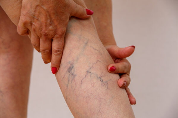 Elderly woman in white panties shows cellulite and varicose veins on a light isolated background. Concept for medicine and cosmetology.